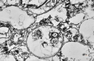 M,50y. | Pneumocystis carinii M,50y. | Pneumocystis carinii